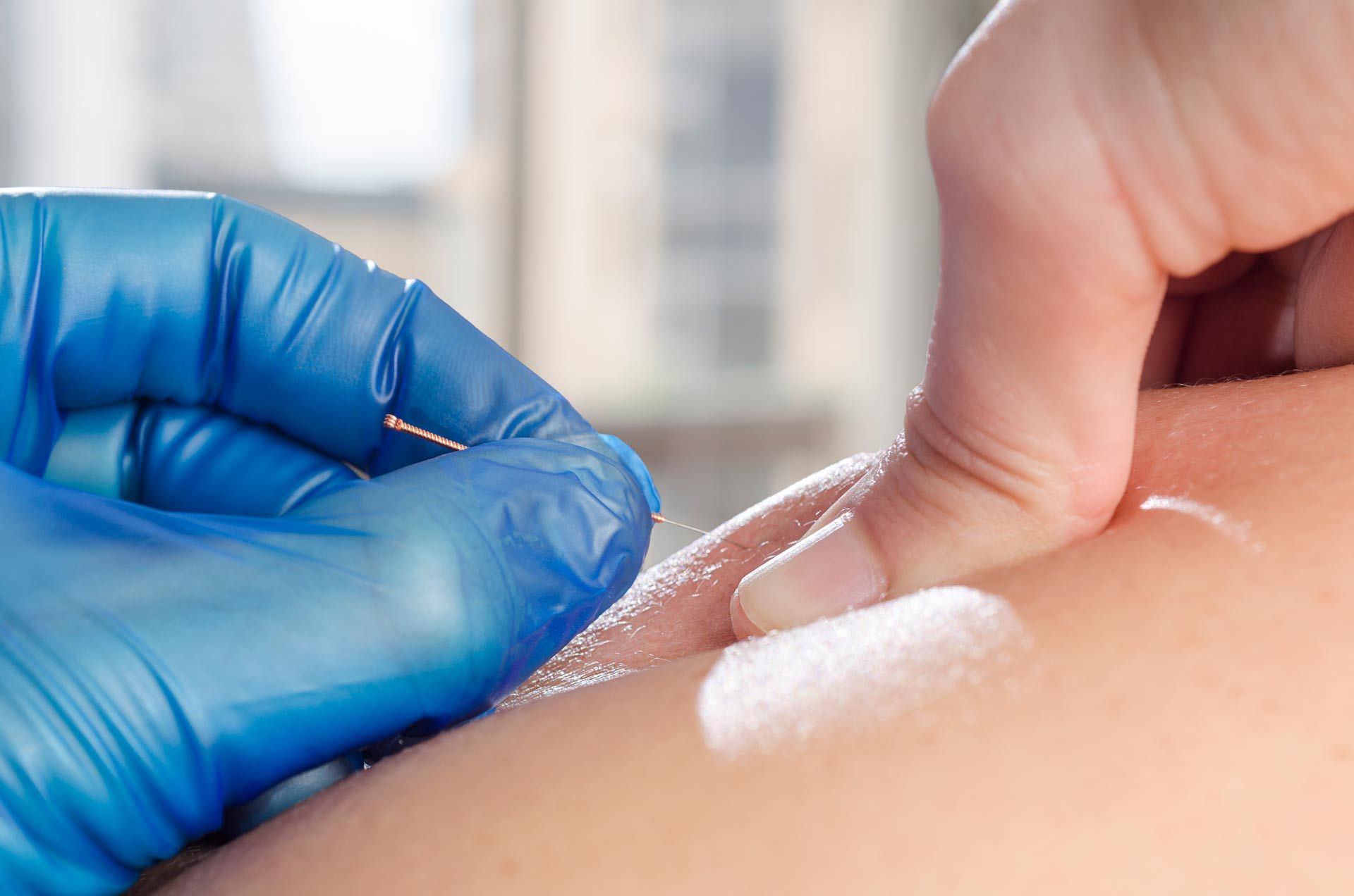 A person is getting an acupuncture treatment on their arm.