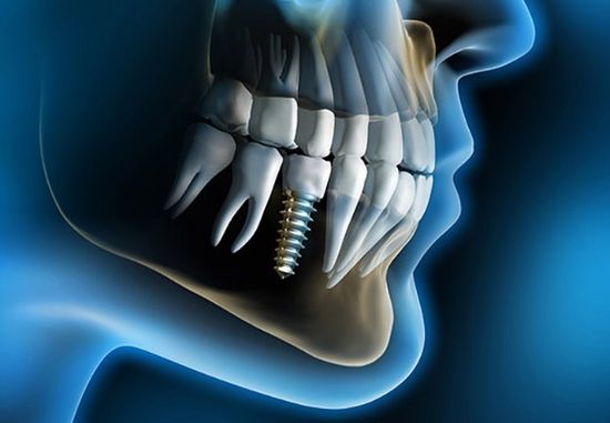 impianti dentali a Novara
