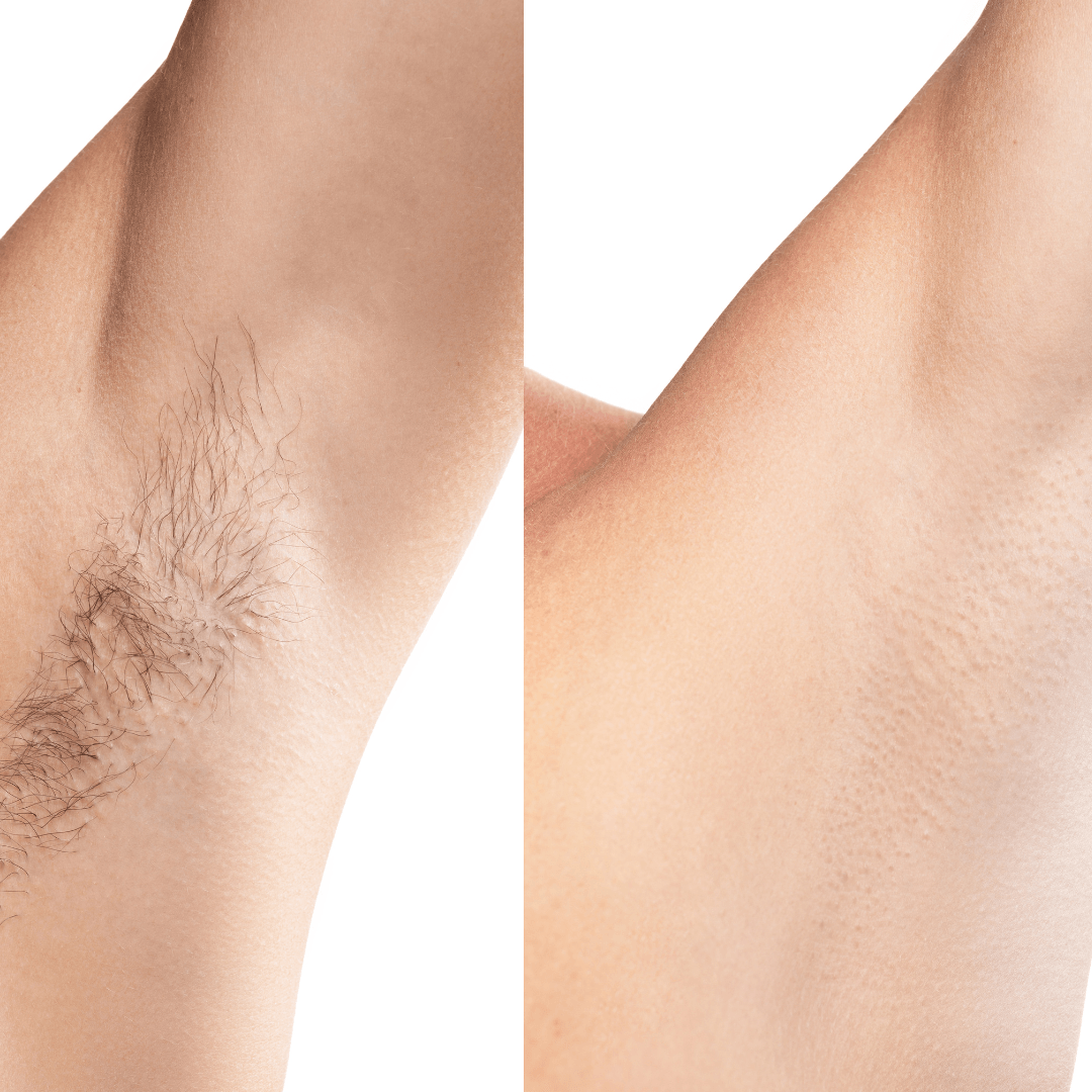 A before and after picture of a woman 's armpit.