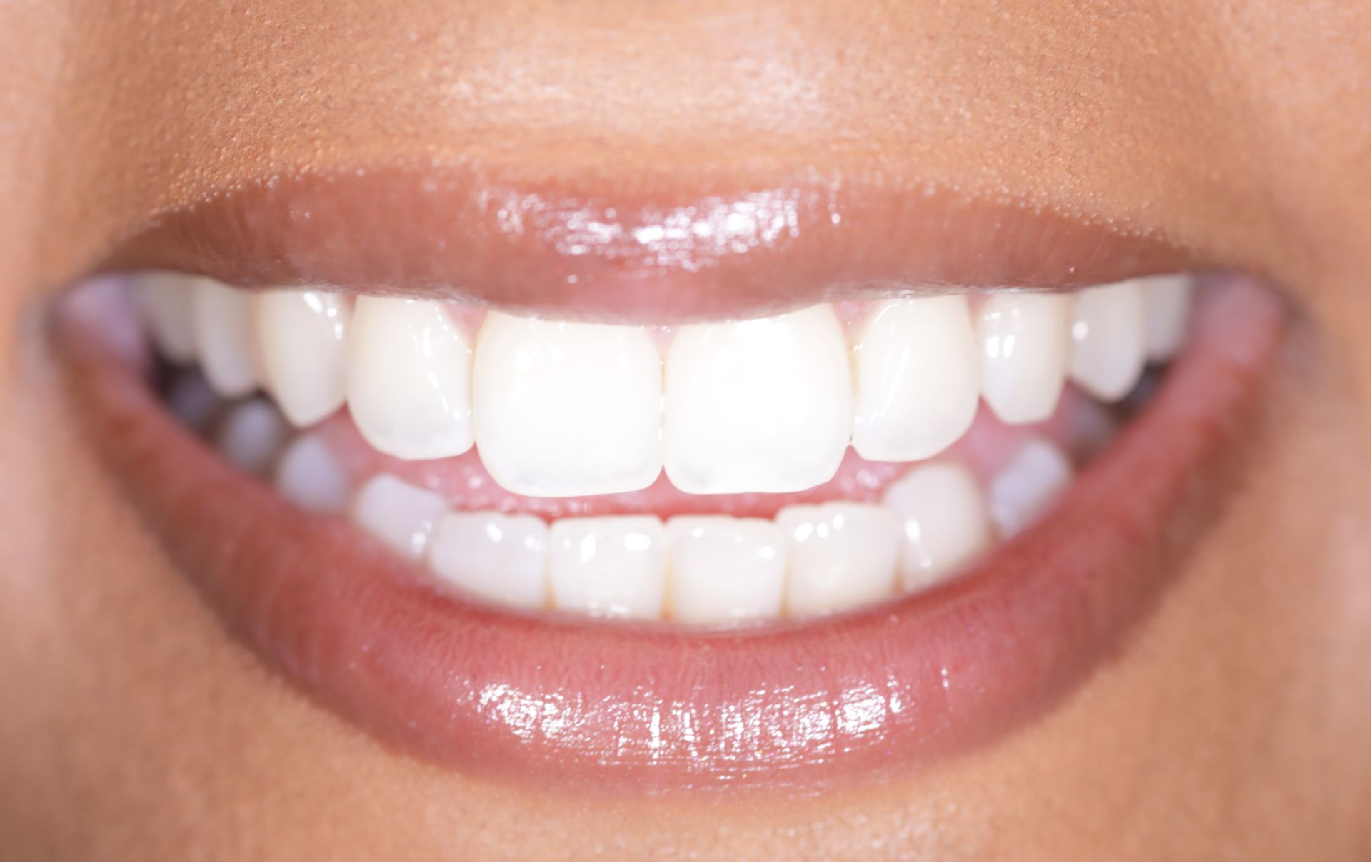 Sbiancamento dentale