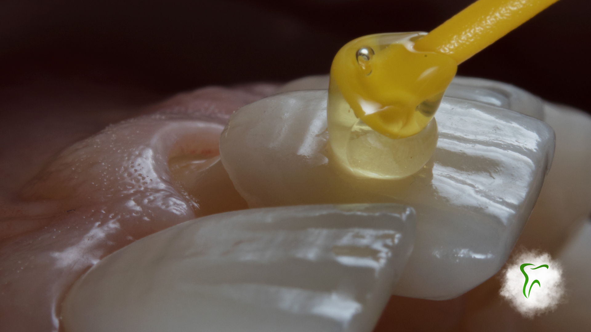 Close-up of a tooth receiving yellow adhesive applied by a small tool during a dental procedure.