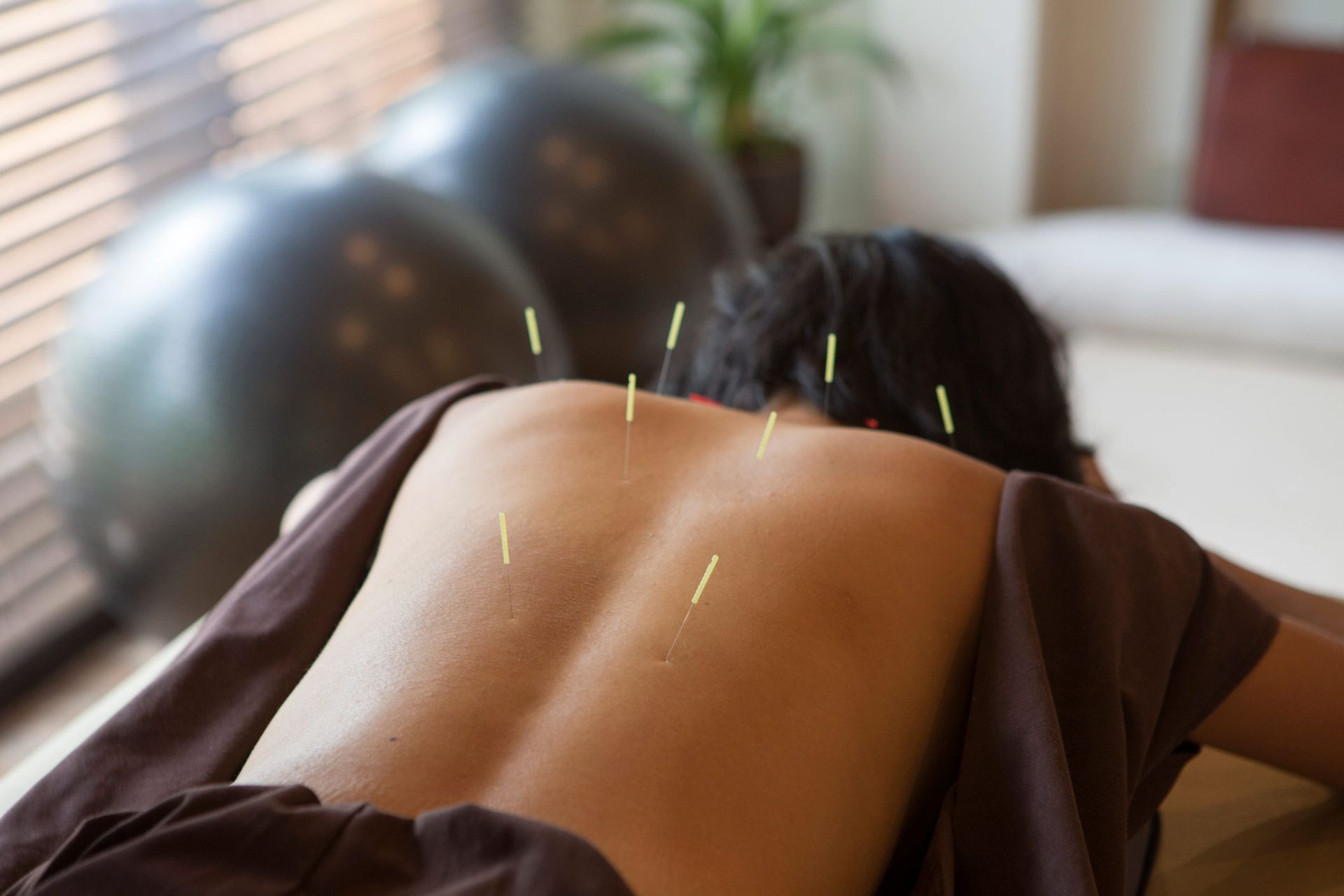 Female get acupuncture treatment | Kiralee, QLD | Master Therapies