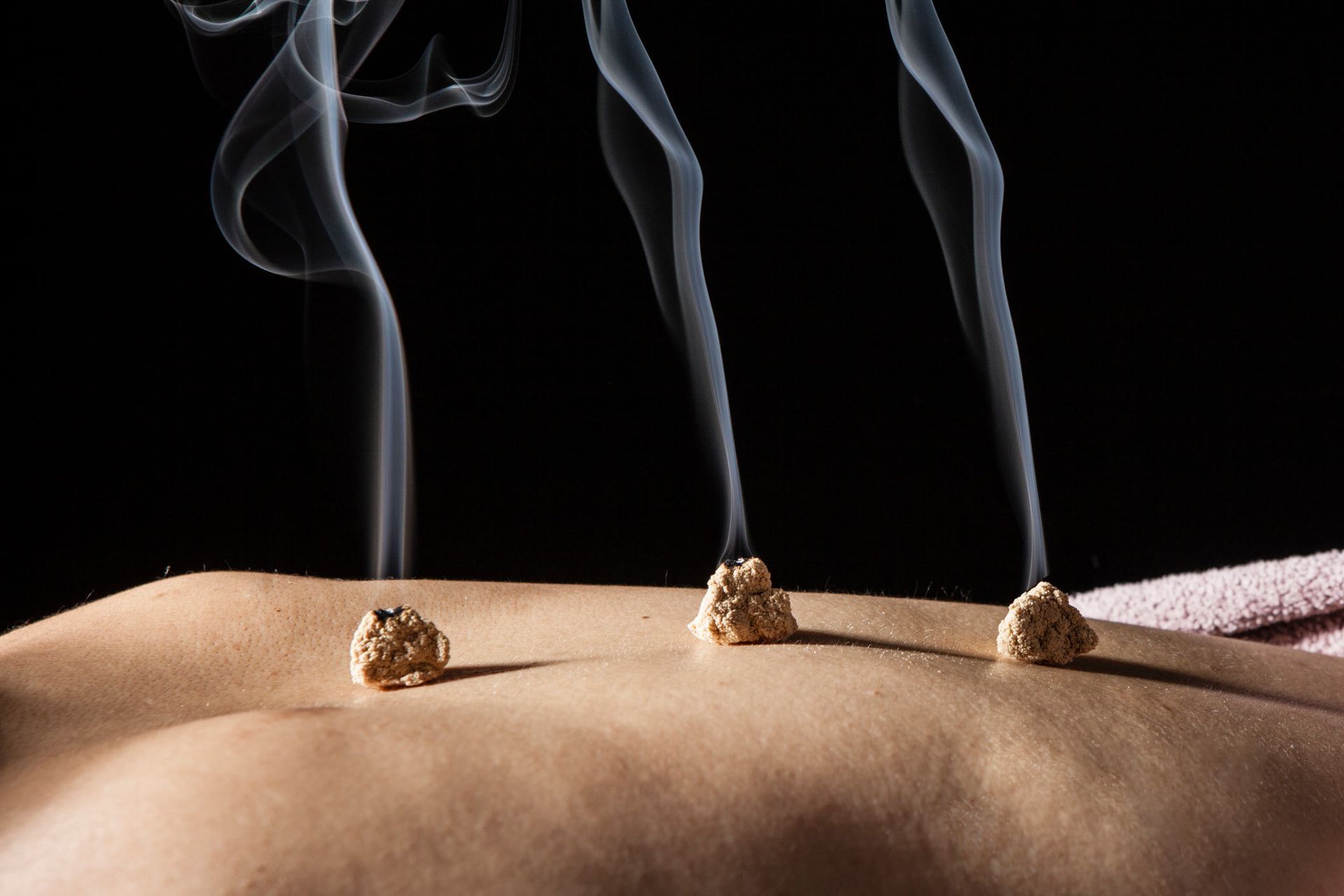 Female get moxibustion treatment | Kiralee, QLD | Master Therapies