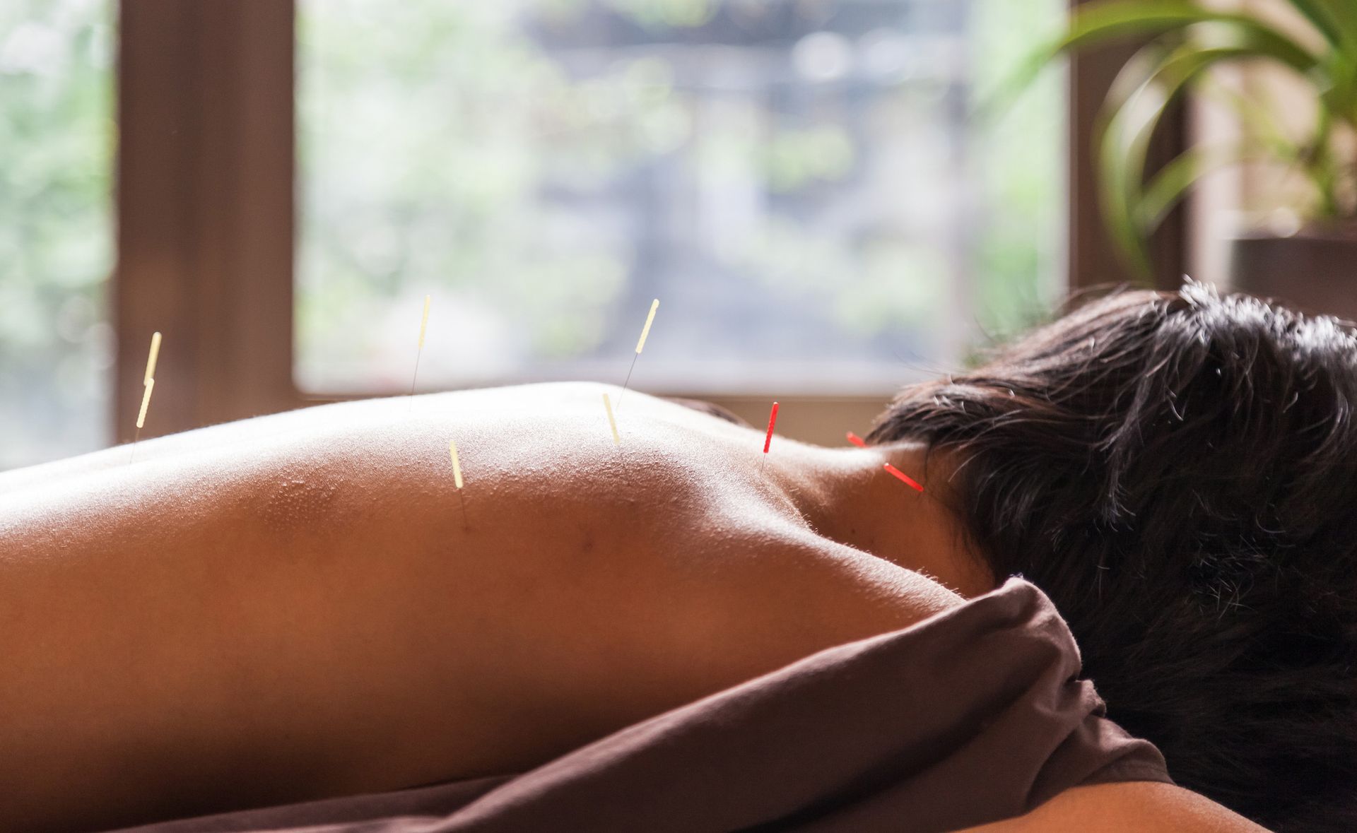 Woman getting face acupuncture | Kiralee, QLD | Master Therapies