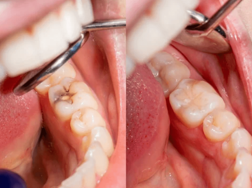 Two views of a tooth with a dental filling before (left) and after (right) treatment.