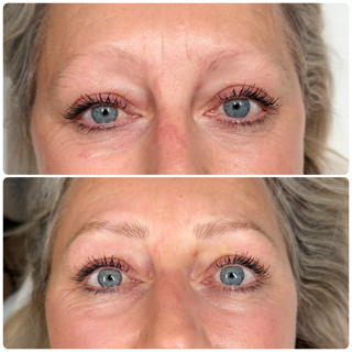 Two close-up photos of blue eyes, one before and one after cosmetic eyelid treatment
