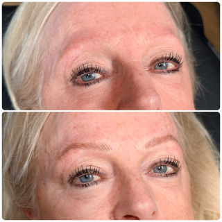 Close-up before-and-after of eyes and eyebrows, showing lifted brows and smoother skin.