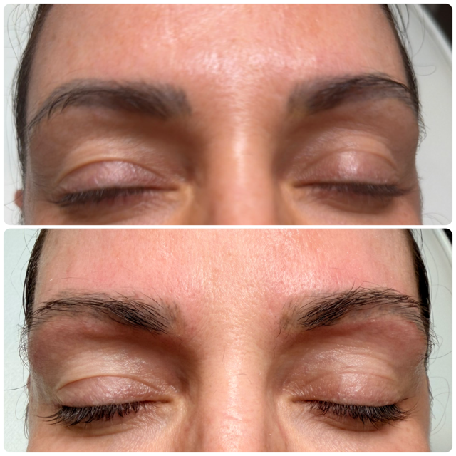 Laser Eyebrow Tattoo Removal 7