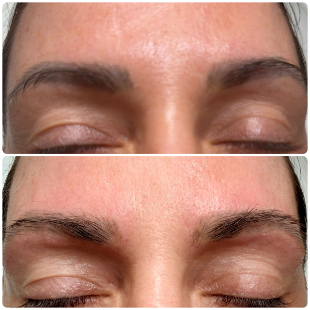 Laser Eyebrow Tattoo Removal 5

