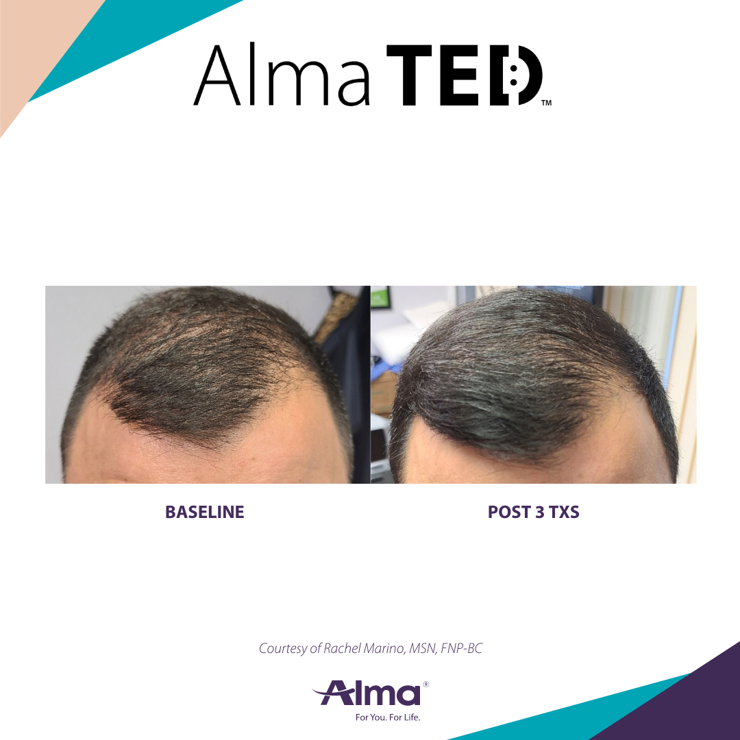 picture of a person's scalp before and after Alma Ted hair loss treatment