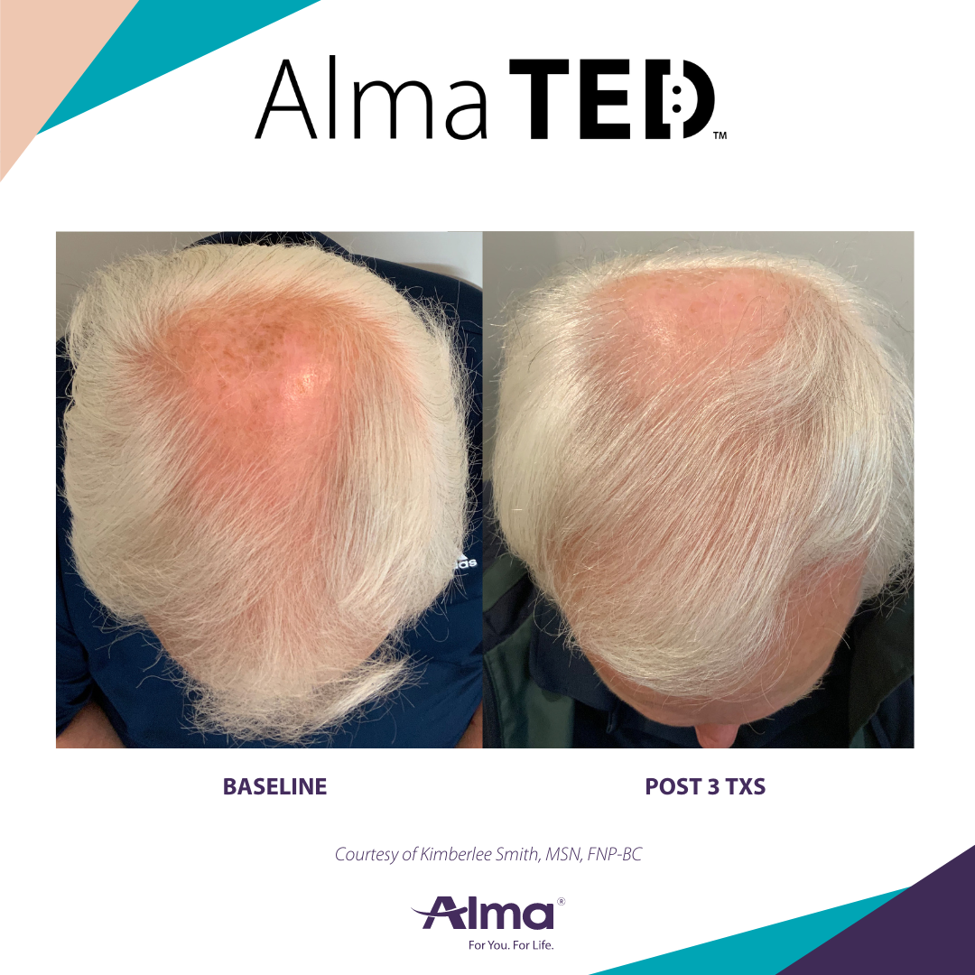 picture of a person's scalp before and after Alma Ted hair loss treatment