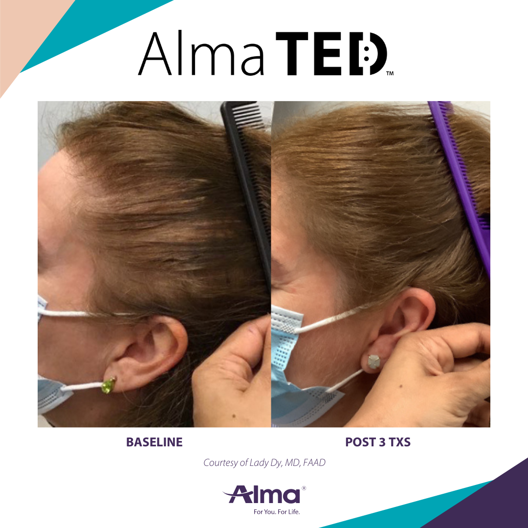 picture of a person's scalp before and after Alma Ted hair loss treatment