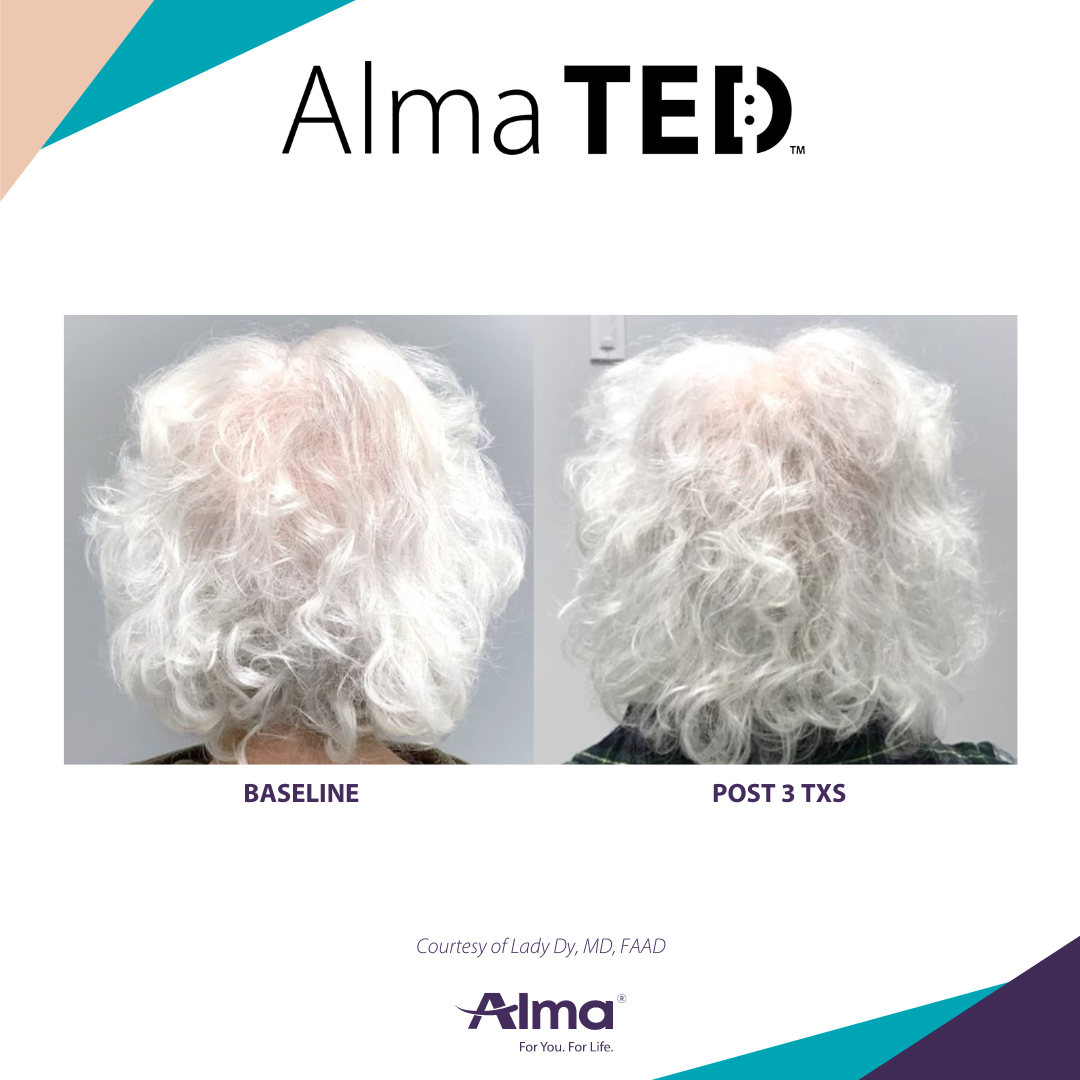 picture of a person's scalp before and after Alma Ted hair loss treatment