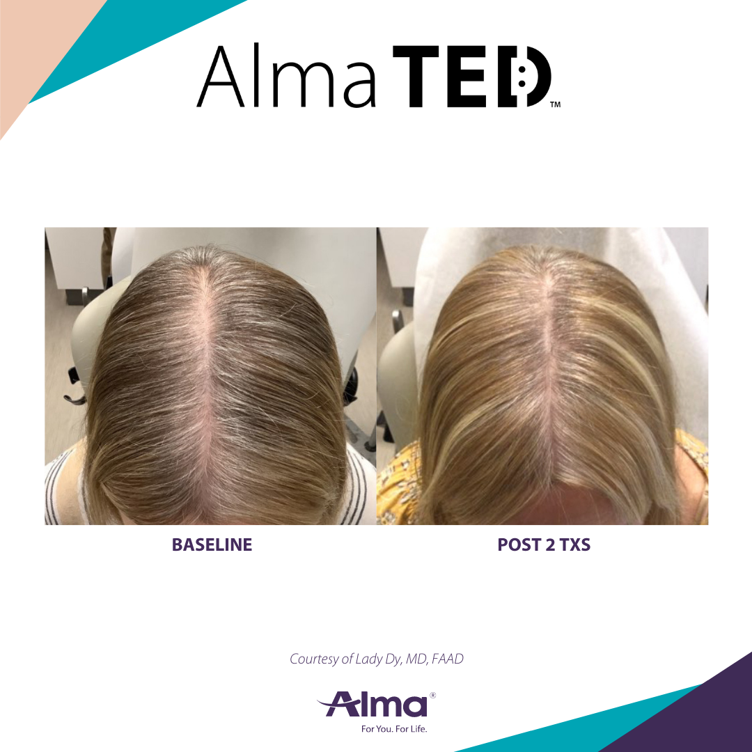 picture of a person's scalp before and after Alma Ted hair loss treatment