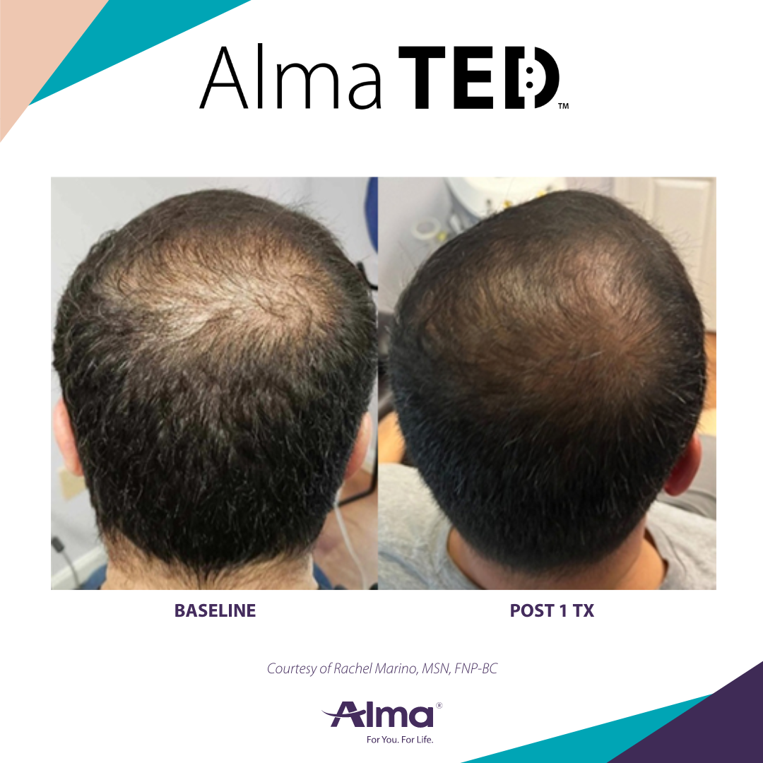 picture of a person's scalp before and after Alma Ted hair loss treatment