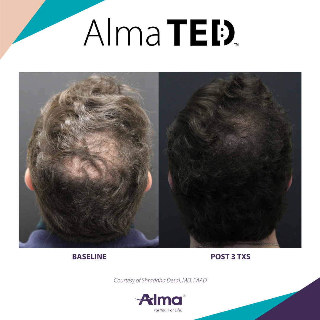 picture of a person's scalp before and after Alma Ted hair loss treatment
