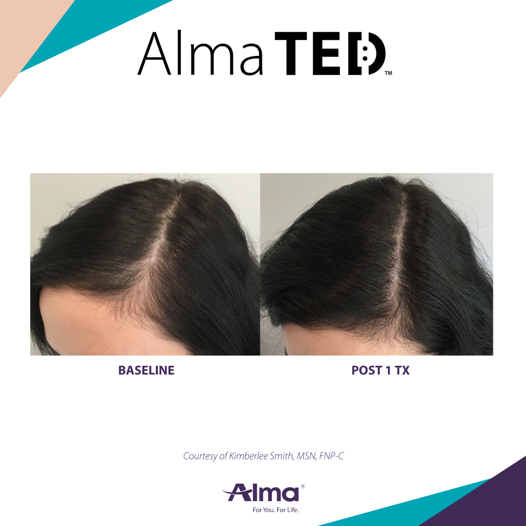 picture of a person's scalp before and after Alma Ted hair loss treatment