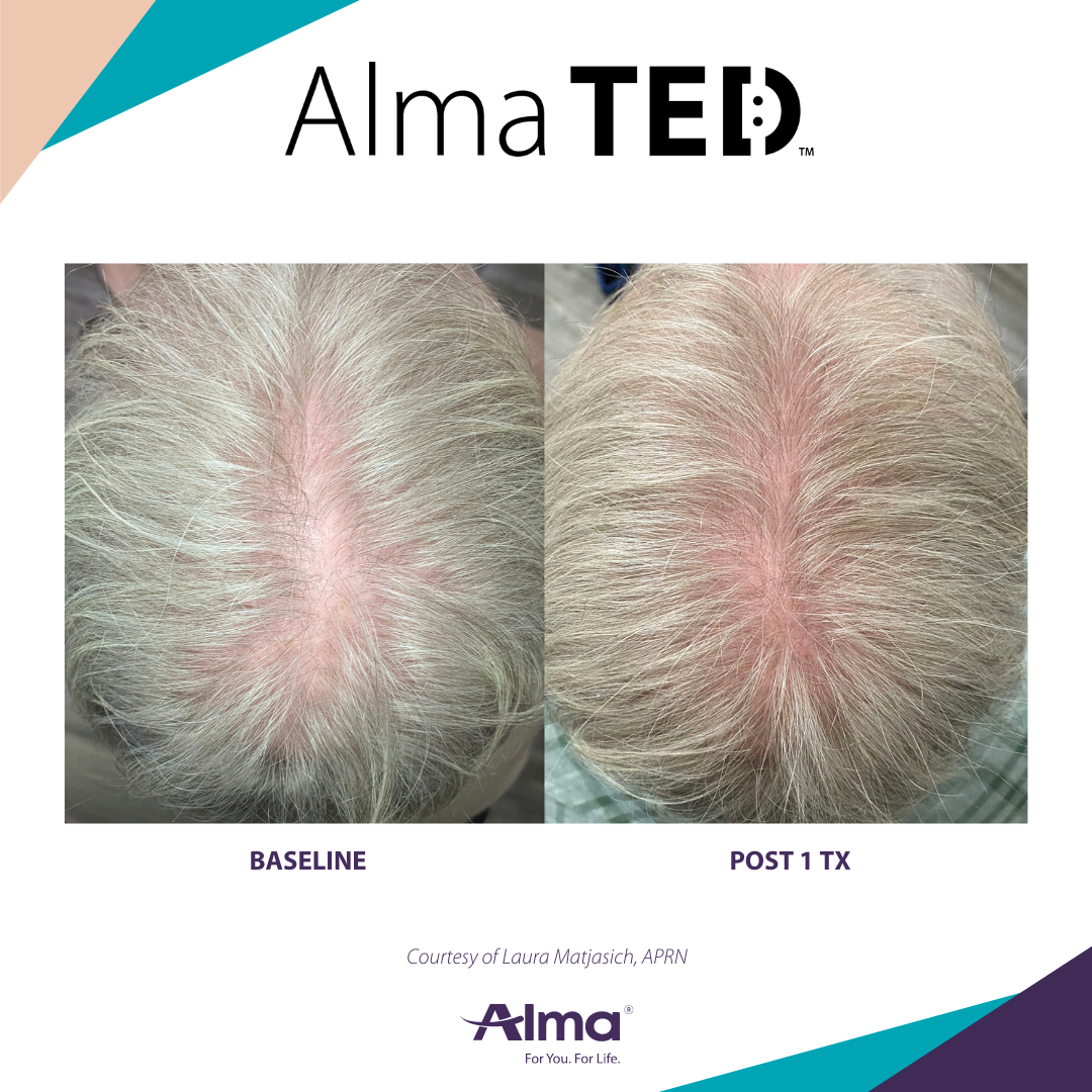 picture of a person's scalp before and after Alma Ted hair loss treatment