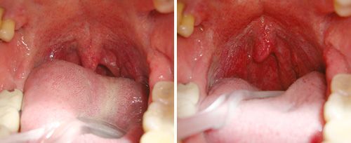 picture of a person's mouth before and after nightlase sleep apnea laser treatment