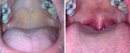 picture of a person's mouth before and after nightlase sleep apnea laser treatment