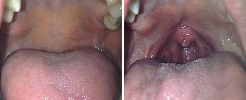 picture of a person's mouth before and after nightlase sleep apnea laser treatment