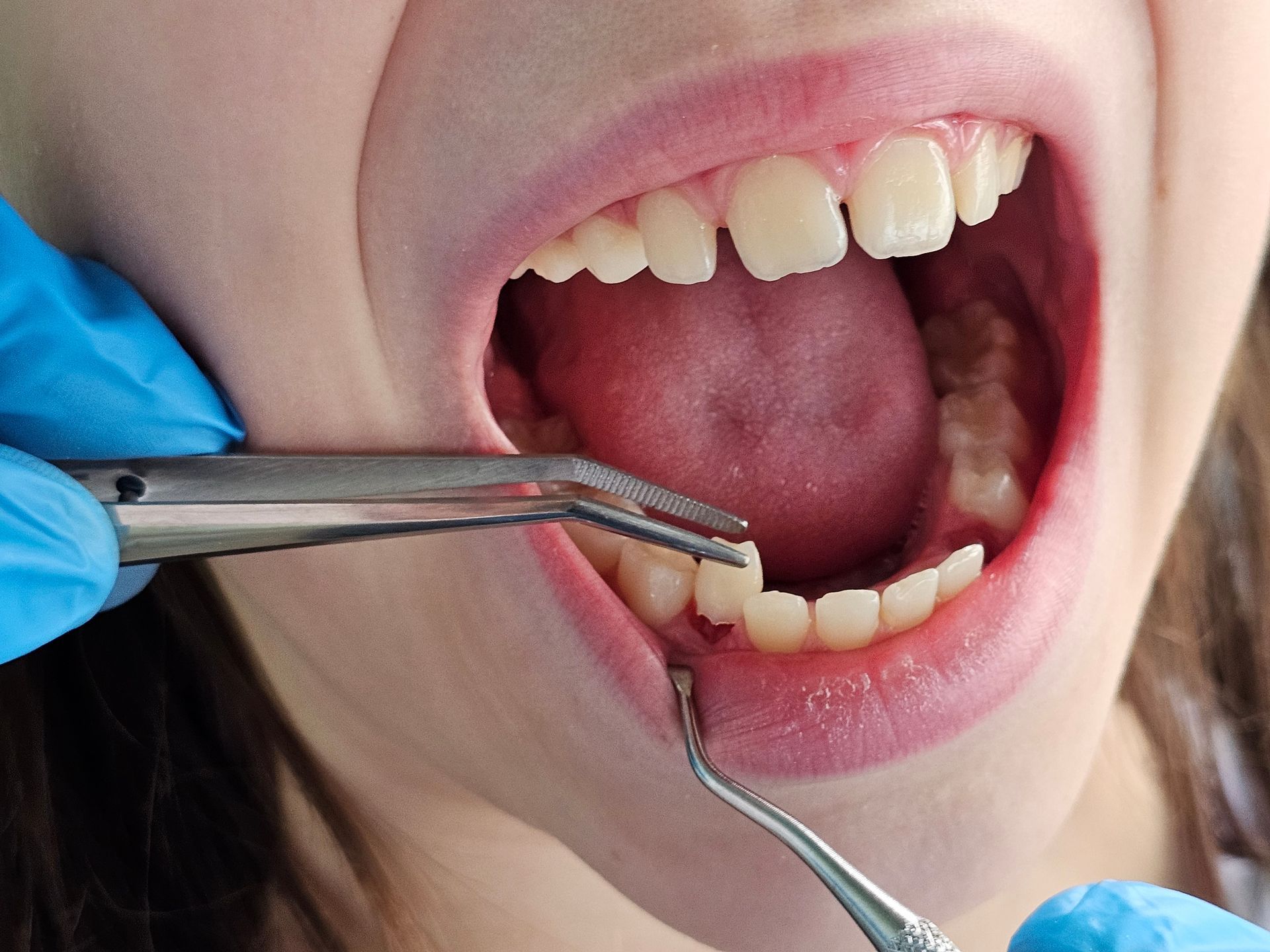 Dental tools examining lower teeth inside an open mouth