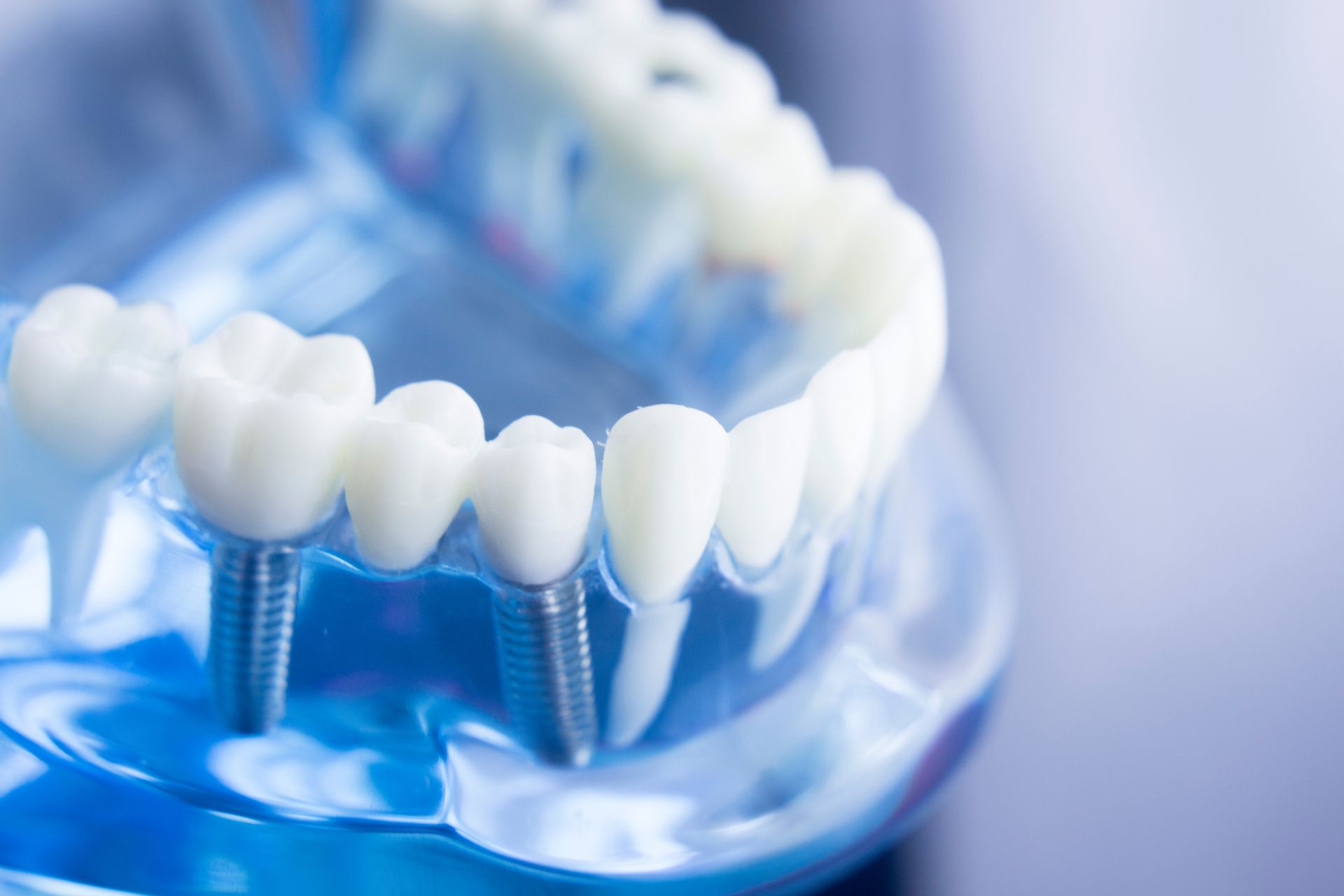 Blue dental implant model with artificial teeth and metal posts on a transparent base
