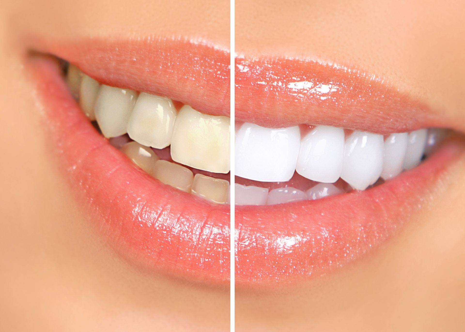 Close-up of smiling lips and teeth, split before-and-after whitening comparison