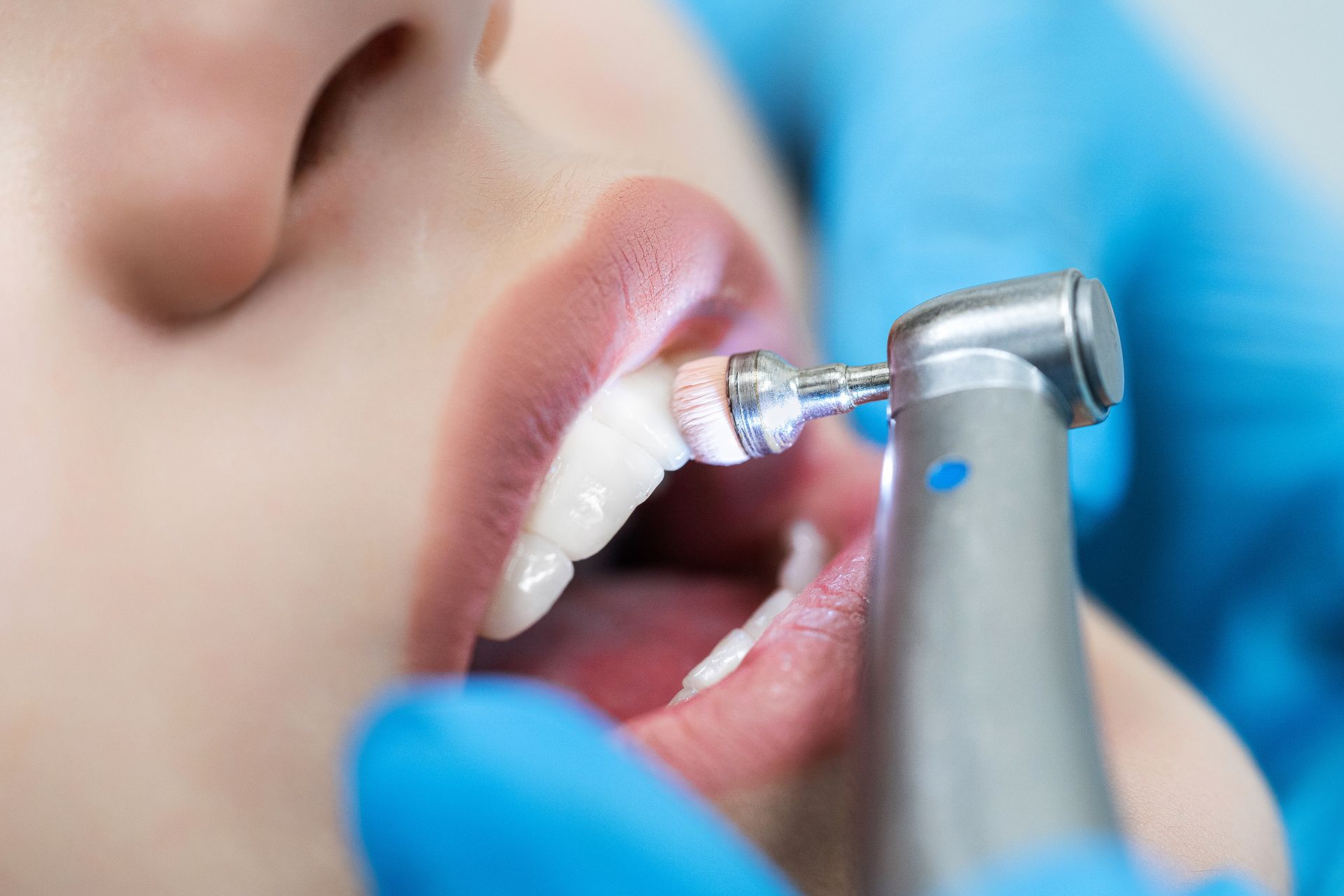 Dental drill cleaning a tooth in a patient's open mouth, with blue-gloved hands nearby
