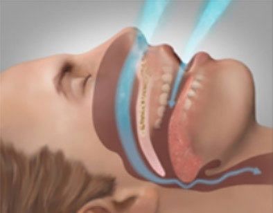 Side-view medical illustration of a person breathing through the nose and mouth, showing the airway in blue.