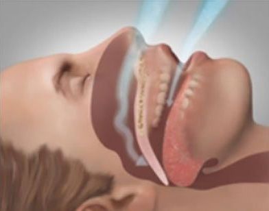 Side-view medical illustration of a person sleeping, showing airflow through the nose and mouth.