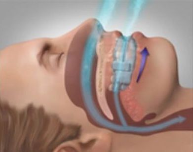 Side-view medical illustration of airflow through the nose and mouth during breathing or CPAP therapy