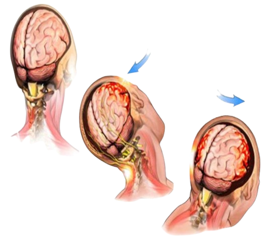 A drawing of a brain with a blue arrow pointing to it