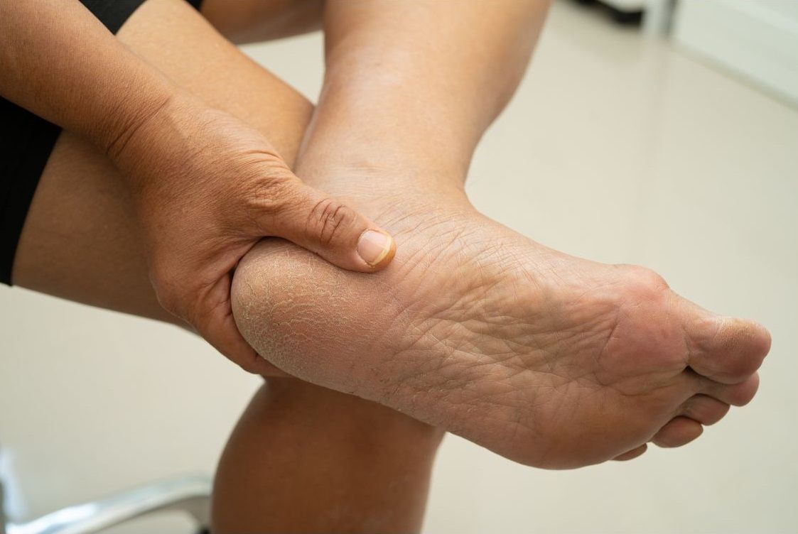 Hands massaging a person’s dry, flaky foot over a white surface