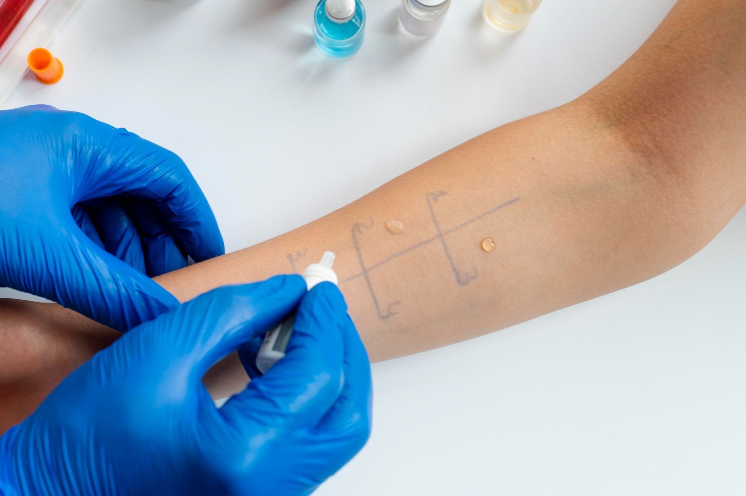 Gloved clinician marking skin for an allergy test with a small applicator on the forearm