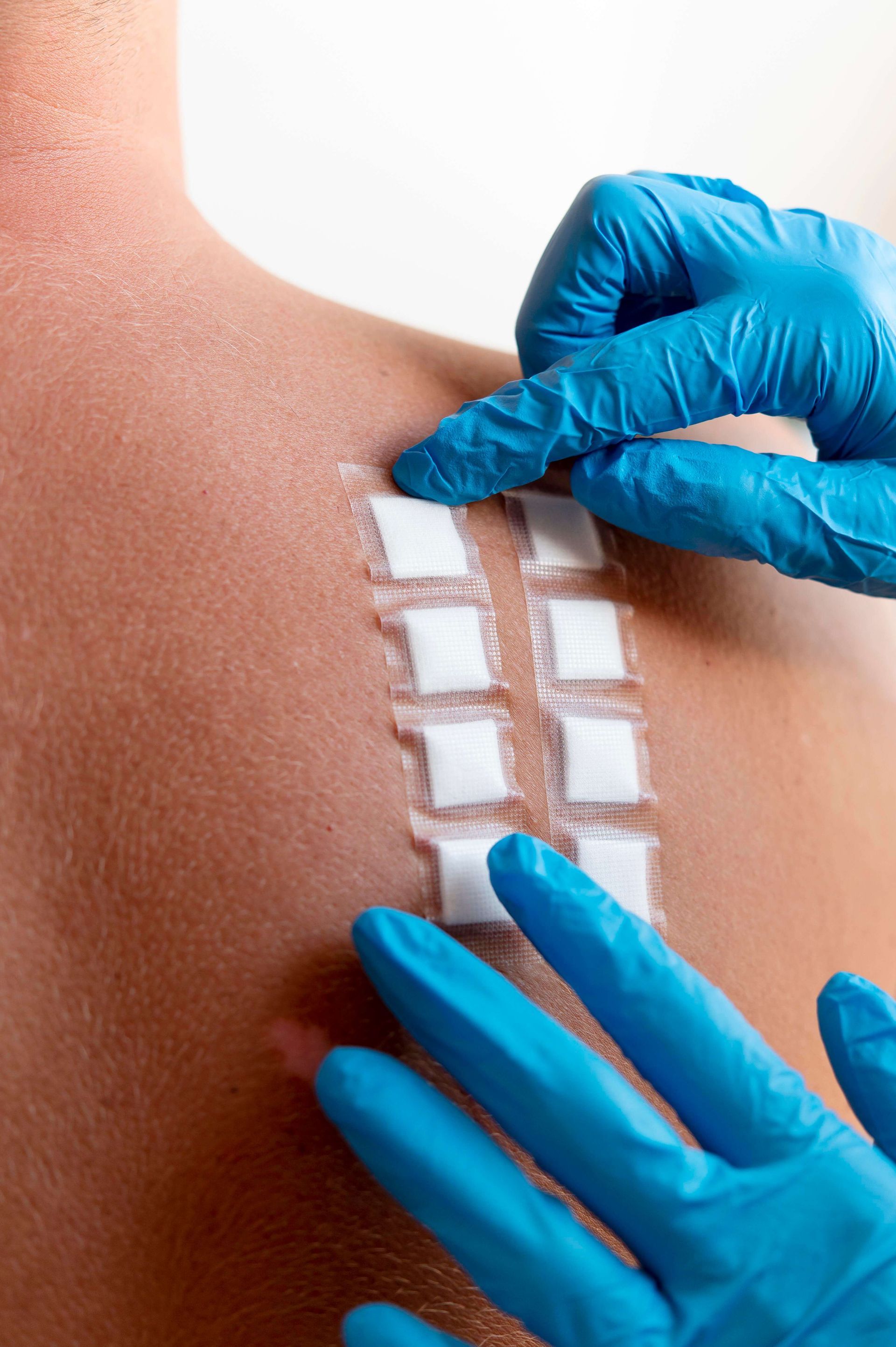 Blue-gloved hands applying adhesive strips to a person’s back in a medical setting