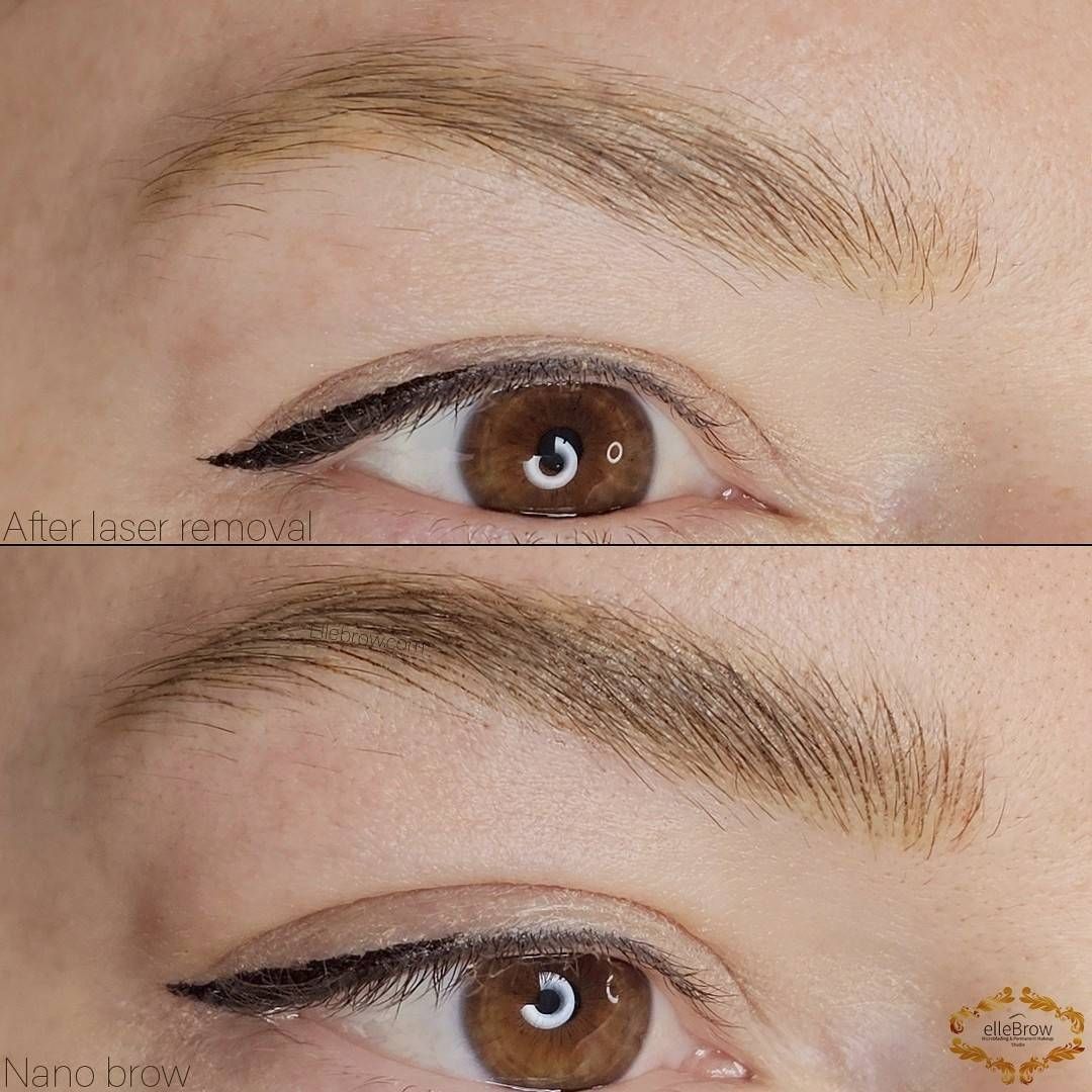 Nano Brows After Laser Removal