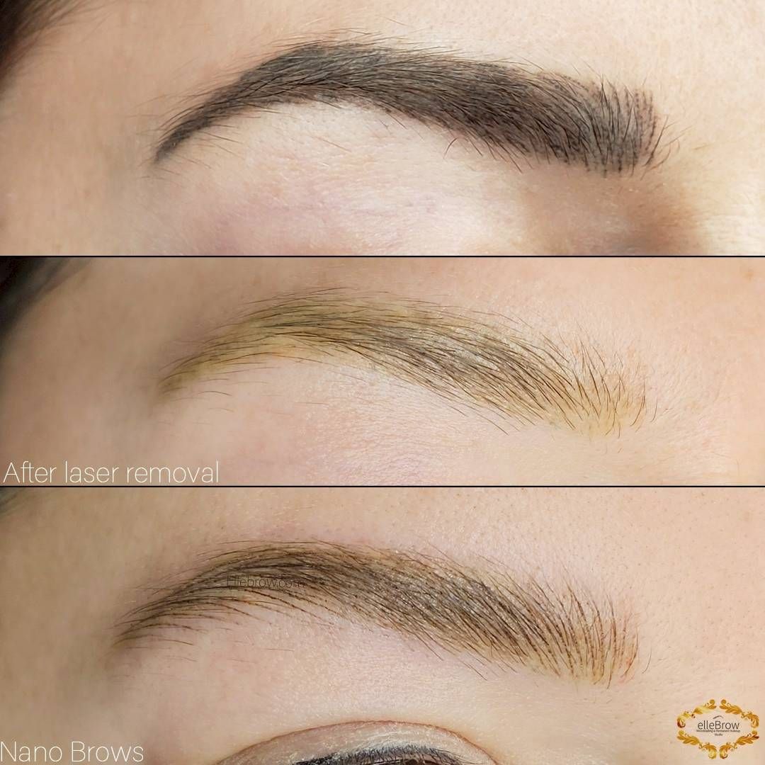 Old Microblading before and after laser removal and after new Nano Brows