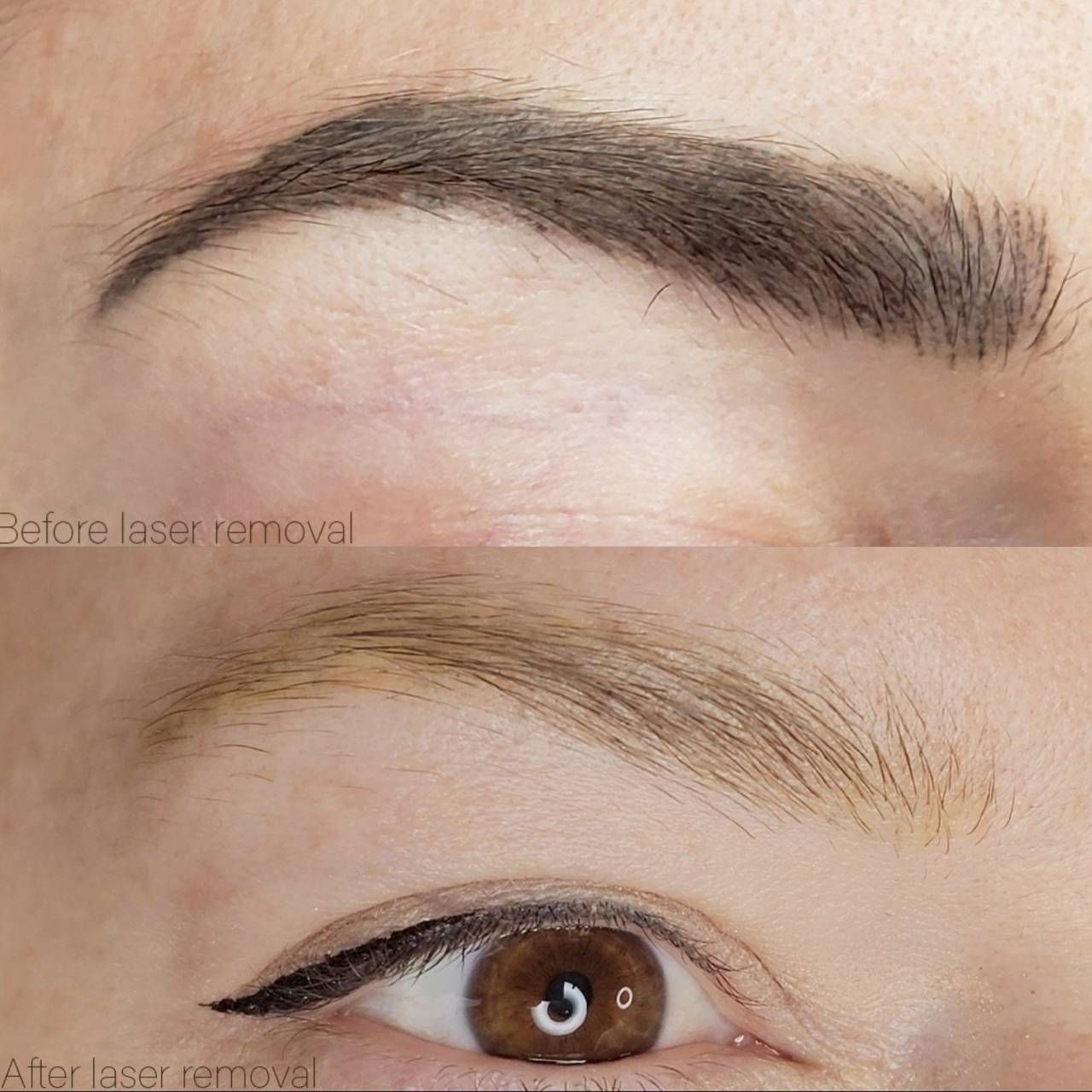 Before and After Eyebrow Microblading Laser Removal