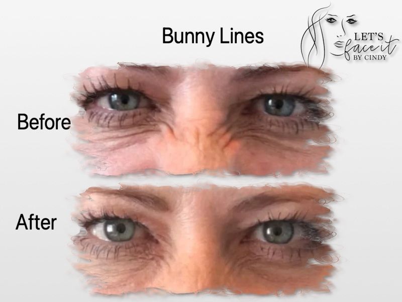 medical-spa-belleville-on-lets-face-it-by-cindy