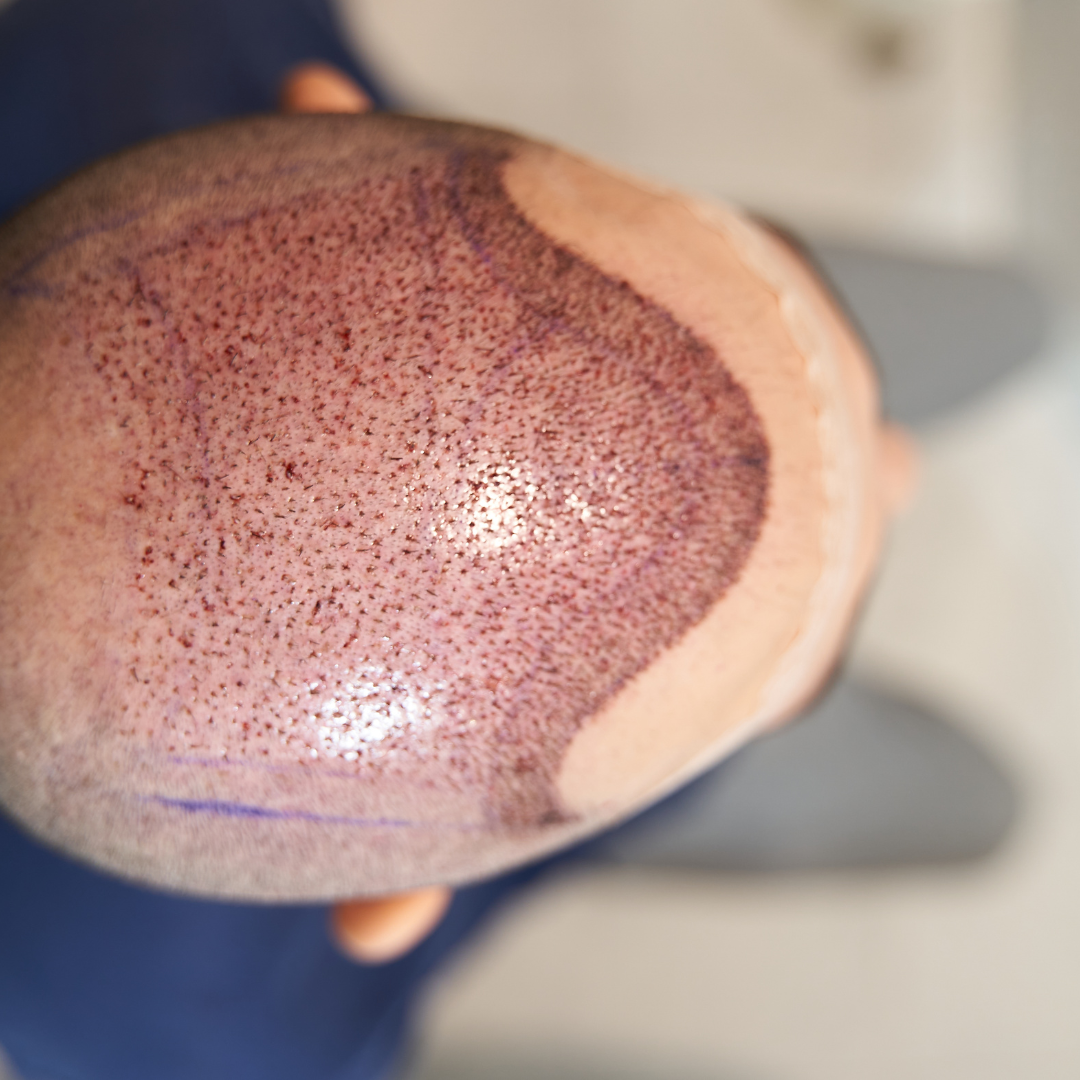Top-down view of a scalp with many small, dark dots and a light-colored area; from a FUE  hair transplant.