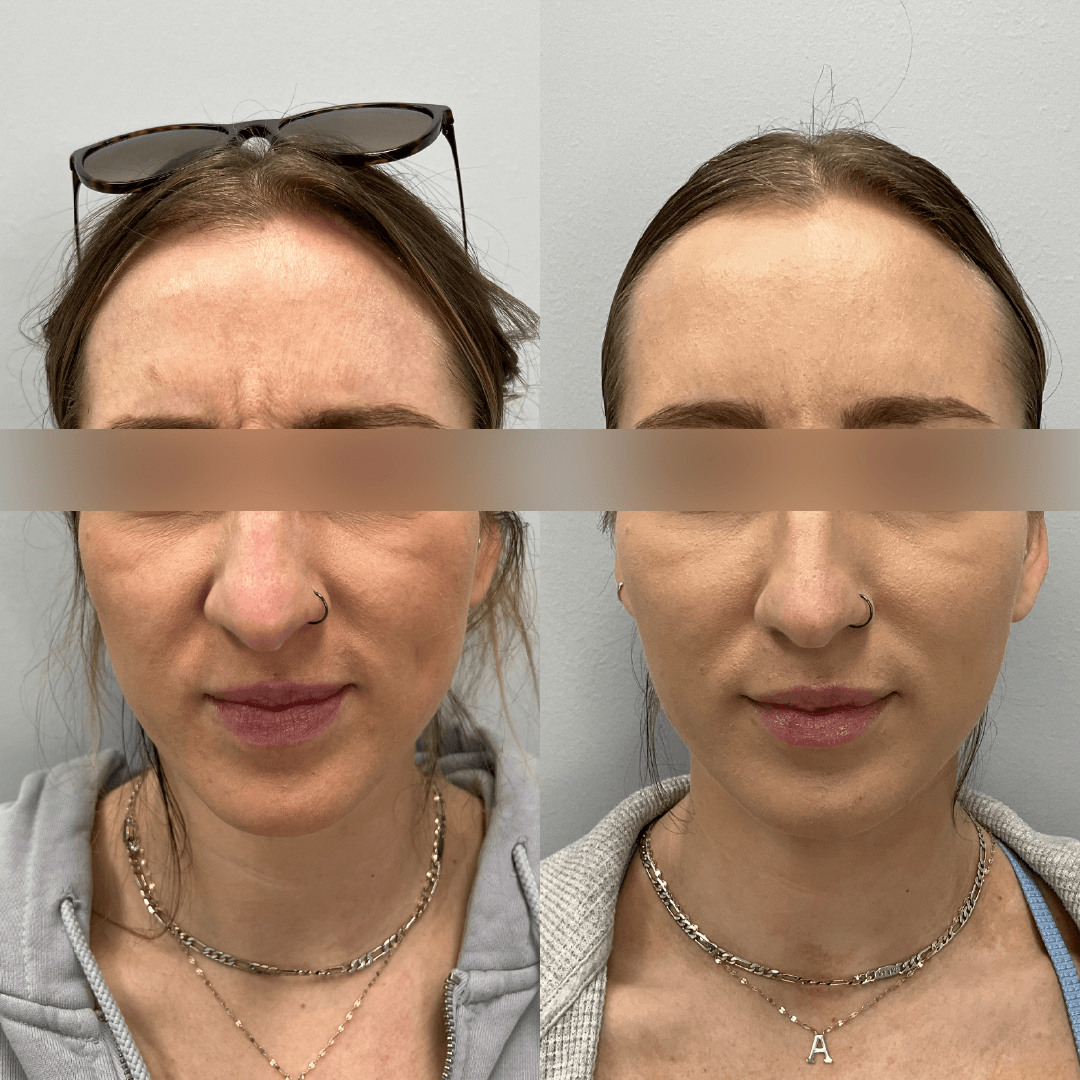 Before-and-after facial comparison: forehead lines reduced, smoother skin.