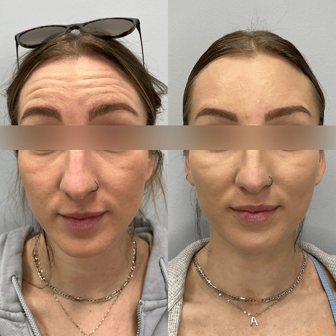 Side-by-side comparison shows a person's forehead wrinkles before and after treatment, face in both photos.