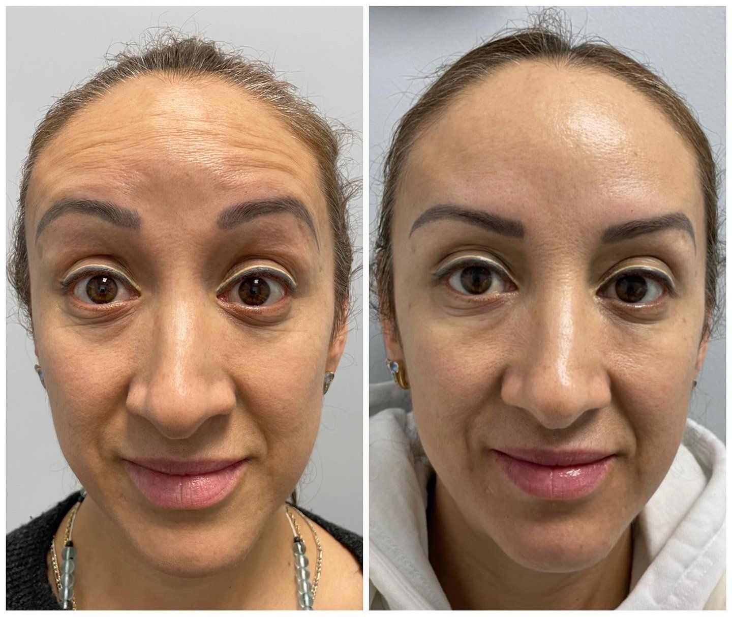 Before and after of a woman's forehead, showing a reduction in wrinkles after a cosmetic procedure.