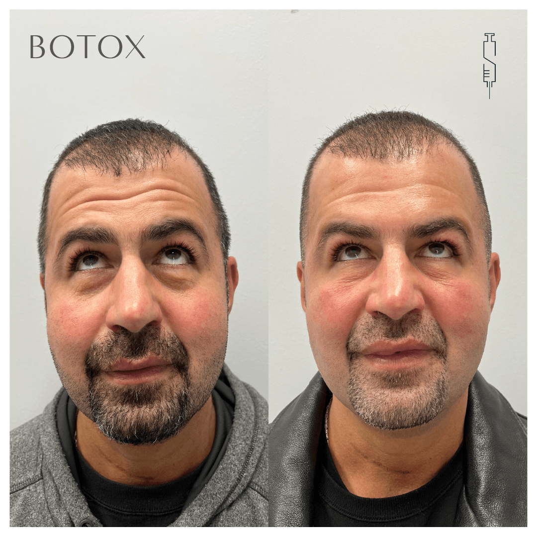 Two side-by-side headshots. Before and after Botox treatment on a male patient from SkinMD, showing wrinkle reduction on forehead.