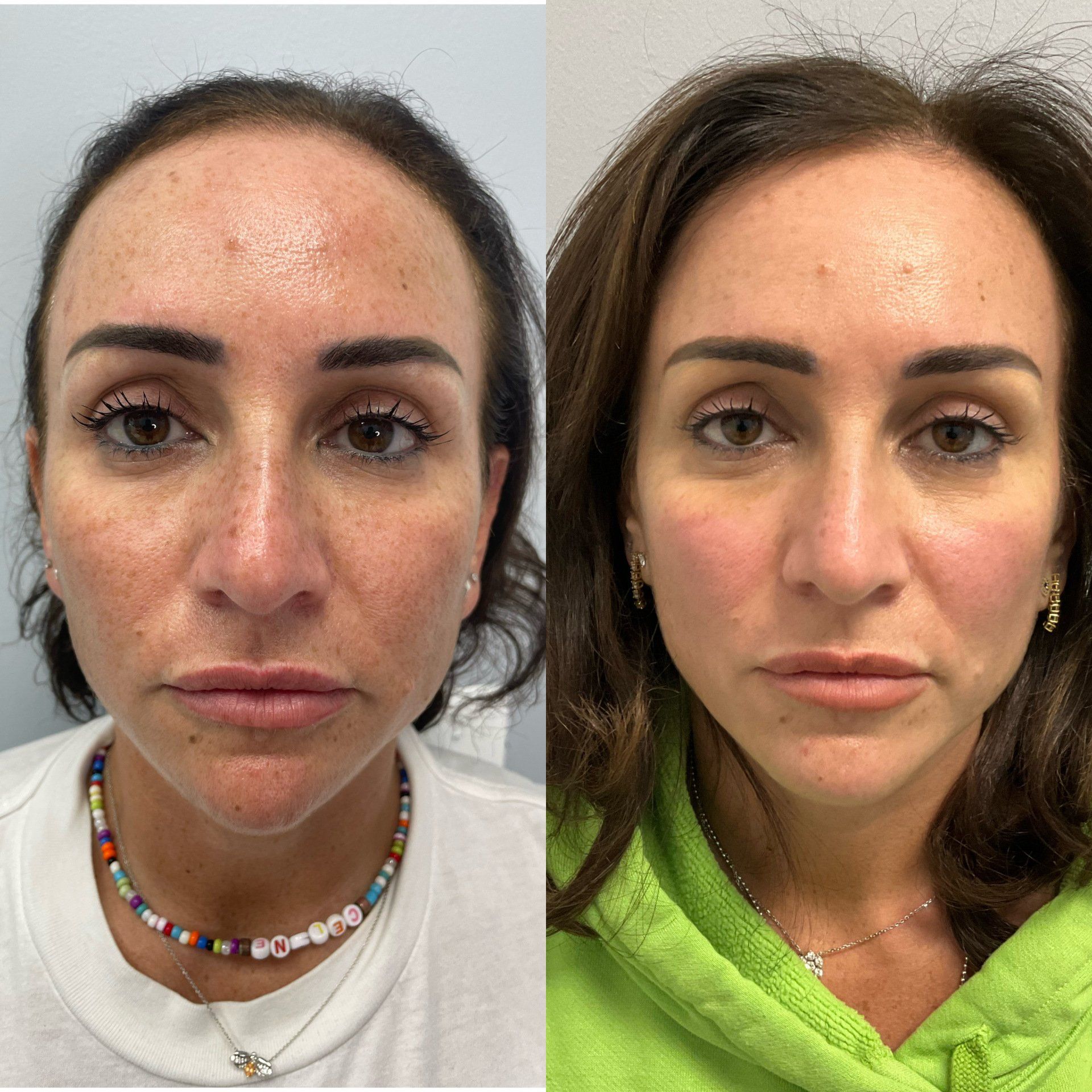 Lutronic laser facial
