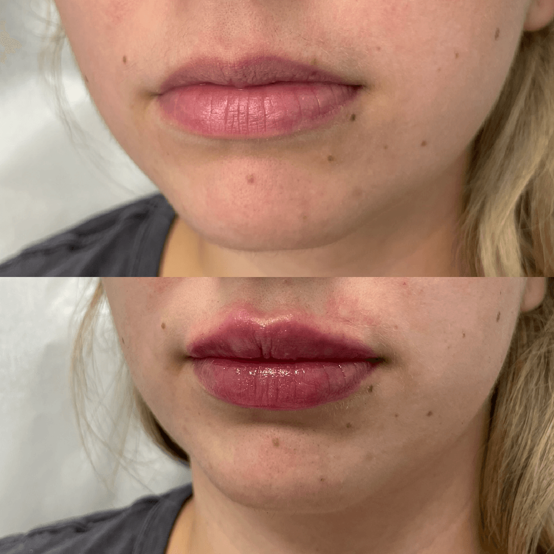 Before and after photo of lip filler. Top: natural lips. Bottom: fuller, enhanced lips.