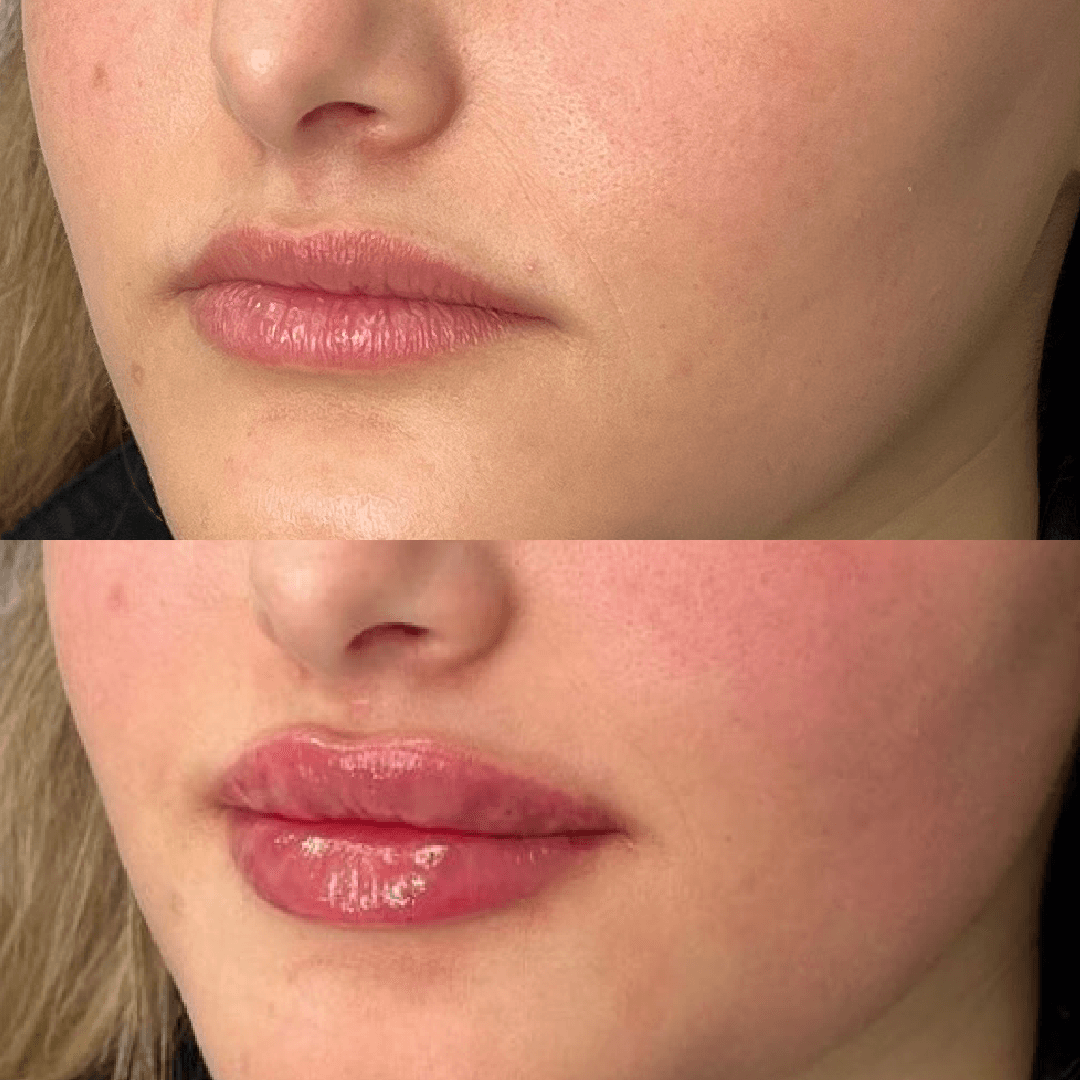 Before and after comparison of lips; upper lips are thin in the first, plump and glossy in the second.