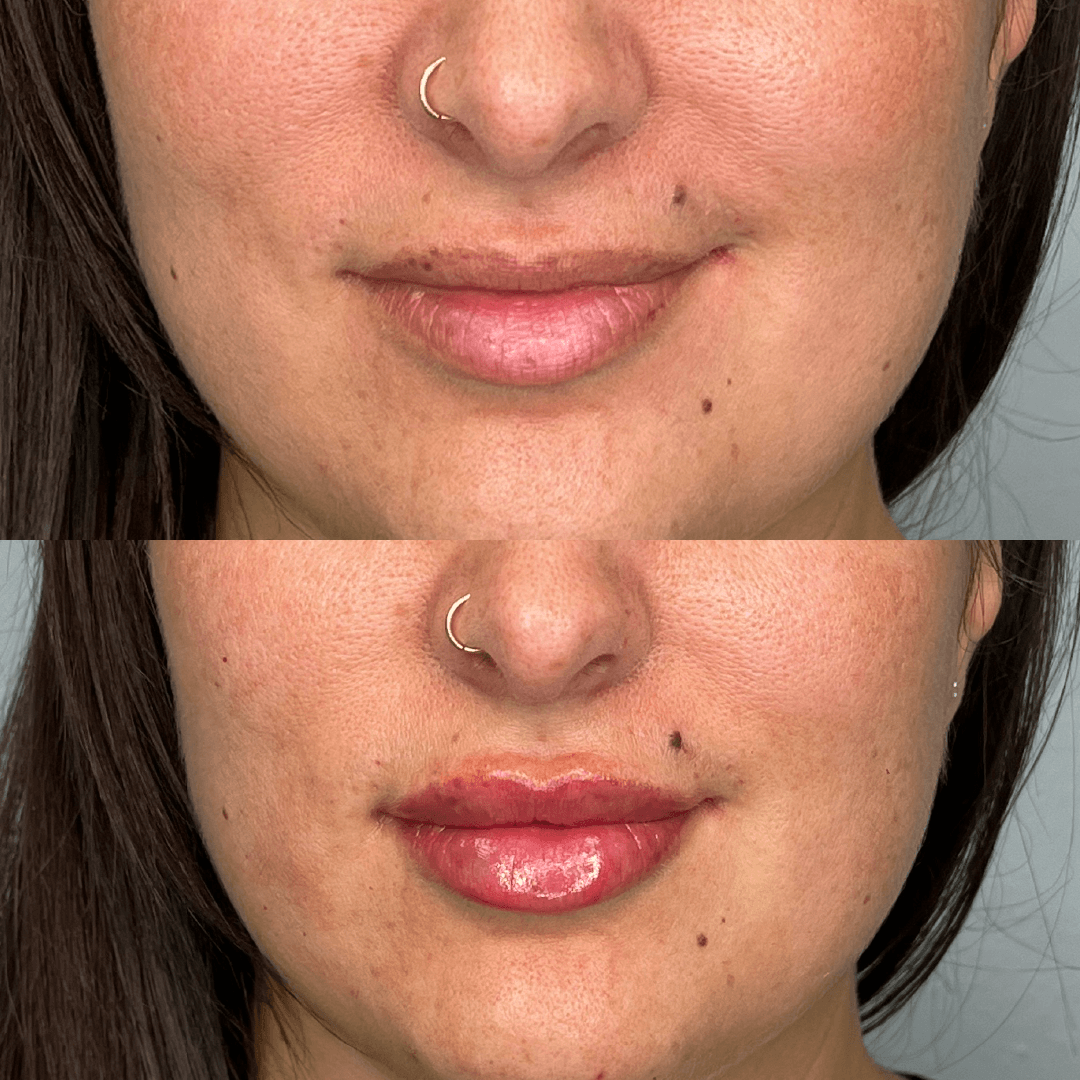Comparison of lips: top, before; bottom, after lip filler, showing fuller shape and size.