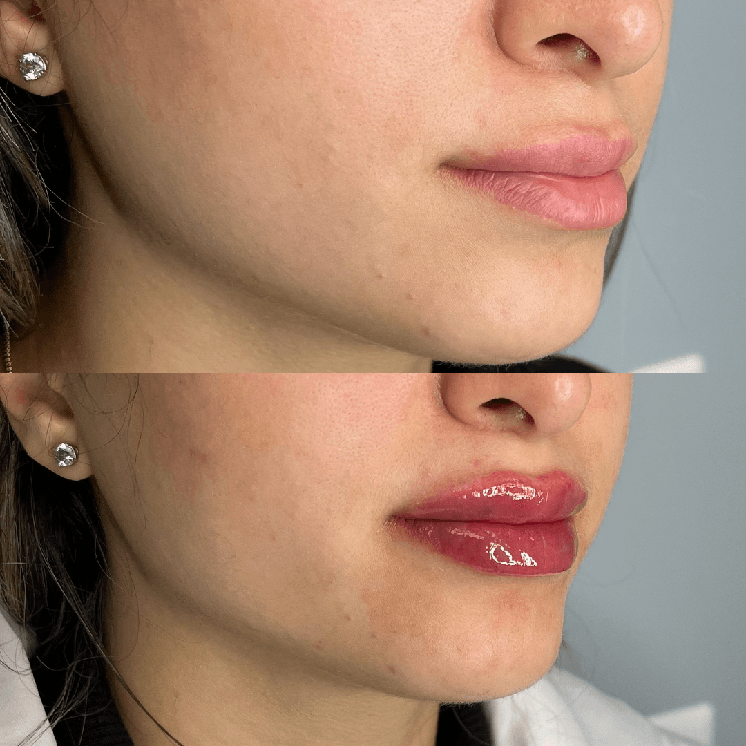 Before and after lip filler treatment: fuller lips, gloss.